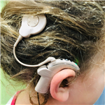 Cochlear Implant (CI)